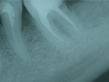 Endodoncia Molar Inferior