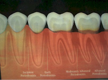 Periodoncia